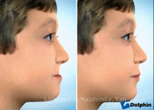 Résultats avec l’appareil extra-oral