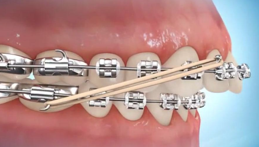 Les élastiques en orthodontie