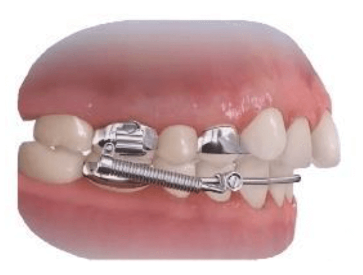 Appareil de stimulation de croissance mandibulaire Crossbow