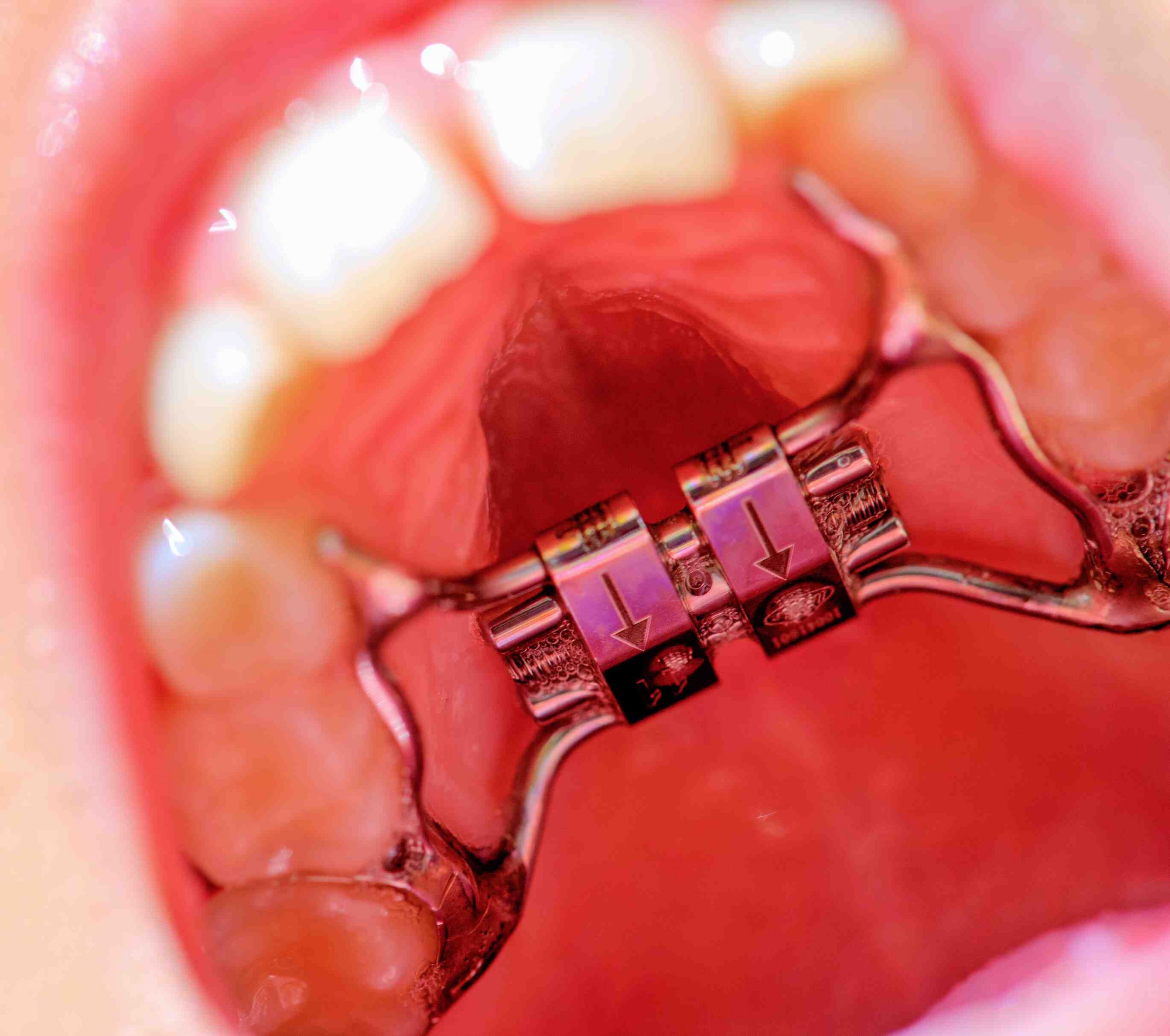 L’appareil d’expansion palatine