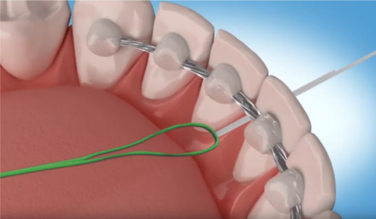 Les fils de rétention